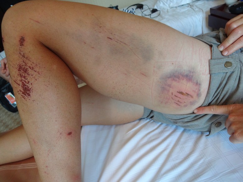 I didn't take a pic of Luke's wounds, but here is Ailsa's instead!